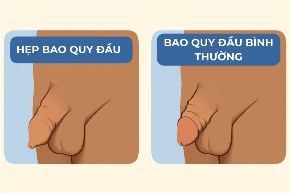 HẸP BAO QUY ĐẦU Ở TRẺ NHỎ